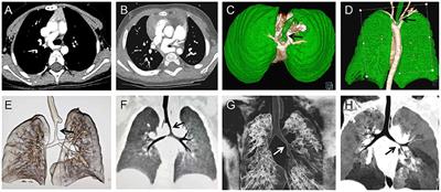 Individualized Analysis and Treatment of Difficult Weaning From Ventilation Following Open Cardiac Surgery in Young Children With Congenital Heart Disease